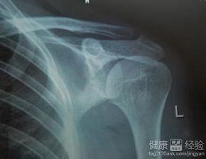 骨折手术后可以吃瓜,骨折手术后饮食指南